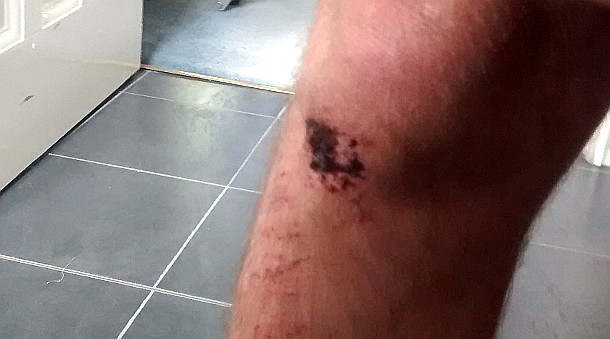 Damaged Knee